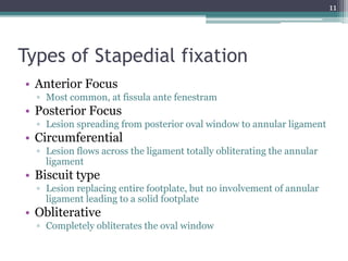 Types of Stapedial fixation
• Anterior Focus
▫ Most common, at fissula ante fenestram
• Posterior Focus
▫ Lesion spreading from posterior oval window to annular ligament
• Circumferential
▫ Lesion flows across the ligament totally obliterating the annular
ligament
• Biscuit type
▫ Lesion replacing entire footplate, but no involvement of annular
ligament leading to a solid footplate
• Obliterative
▫ Completely obliterates the oval window
11
 