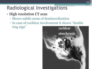 Radiological Investigations
• High resolution CT scan
▫ Shows subtle areas of demineralisation
▫ In case of cochlear involvement it shows “double
ring sign”
24
 
