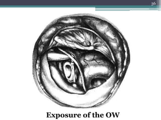 36
Exposure of the OW
 