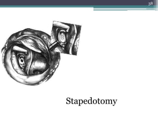 38
Stapedotomy
 