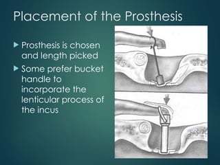 Comprehensive Overview of Otosclerosis: Pathology, Diagnosis, and ...