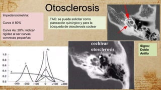 Otosclerosis
Impedanciometría:
Curva A 80%
Curva As: 20%: indican
rigidez al ser curvas
convexas pequeñas
TAC: se puede solicitar como
planeación quirúrgico y para la
búsqueda de otosclerosis coclear
Signo:
Doble
Anillo
 