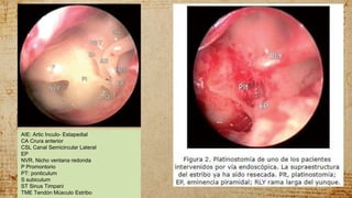 AIE: Artic Inculo- Estapedial
CA Crura anterior
CSL Canal Semicircular Lateral
EP
NVR. Nicho ventana redonda
P Promontorio
PT: ponticulum
S subiculum
ST Sinus Timpani
TME Tendón Músculo Estribo
 