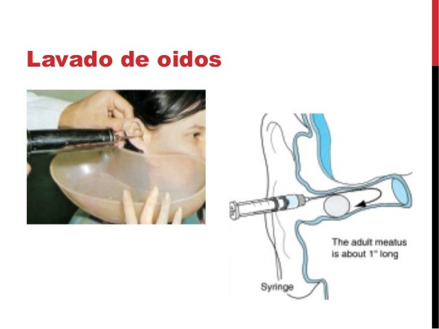 Otoscopia y tapon de cerumen