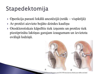  Operācija parasti lokālā anestēzijā (retāk – vispārējā)
 Ar protēzi aizvieto bojāto dzirdes kauliņu
 Otosklerotiskais kāpslītis tiek izņemts un protēze tiek
piestiprināta laktiņas garajam izaugumam un ievietota
ovālajā lodziņā.
http://medicforyou.blogspot.com/2015/09/otosclerosis-third-year-mbbs-ent.html
 