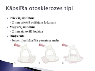  Priekšējais fokus
◦ 2 mm priekšā ovālajam lodziņam
 Mugurējais fokus
◦ 2 mm aiz ovālā lodziņa
 Riņķveida
◦ Ietver tikai kāpslīša pamatnes malu
 