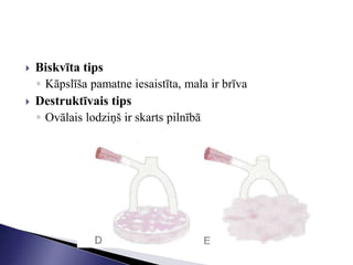  Biskvīta tips
◦ Kāpslīša pamatne iesaistīta, mala ir brīva
 Destruktīvais tips
◦ Ovālais lodziņš ir skarts pilnībā
 