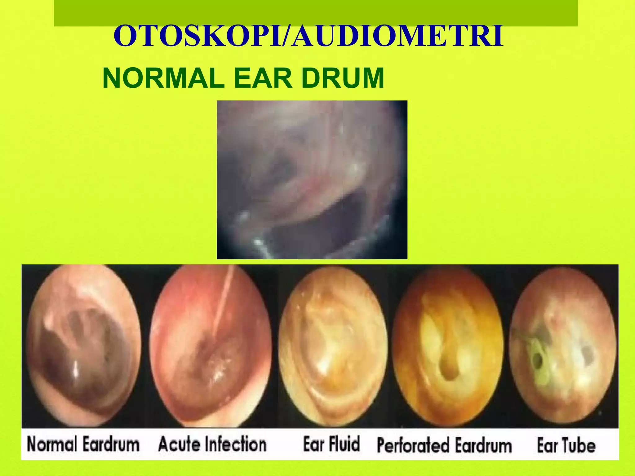 Otoskopi Audiometri | PPT