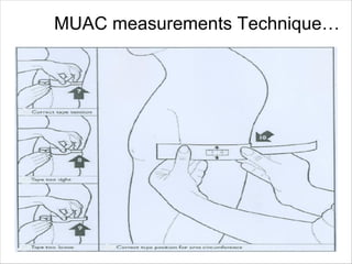 Muac Guidelines Out patient Treatment, ( OTP) MANAGEMENT | PDF