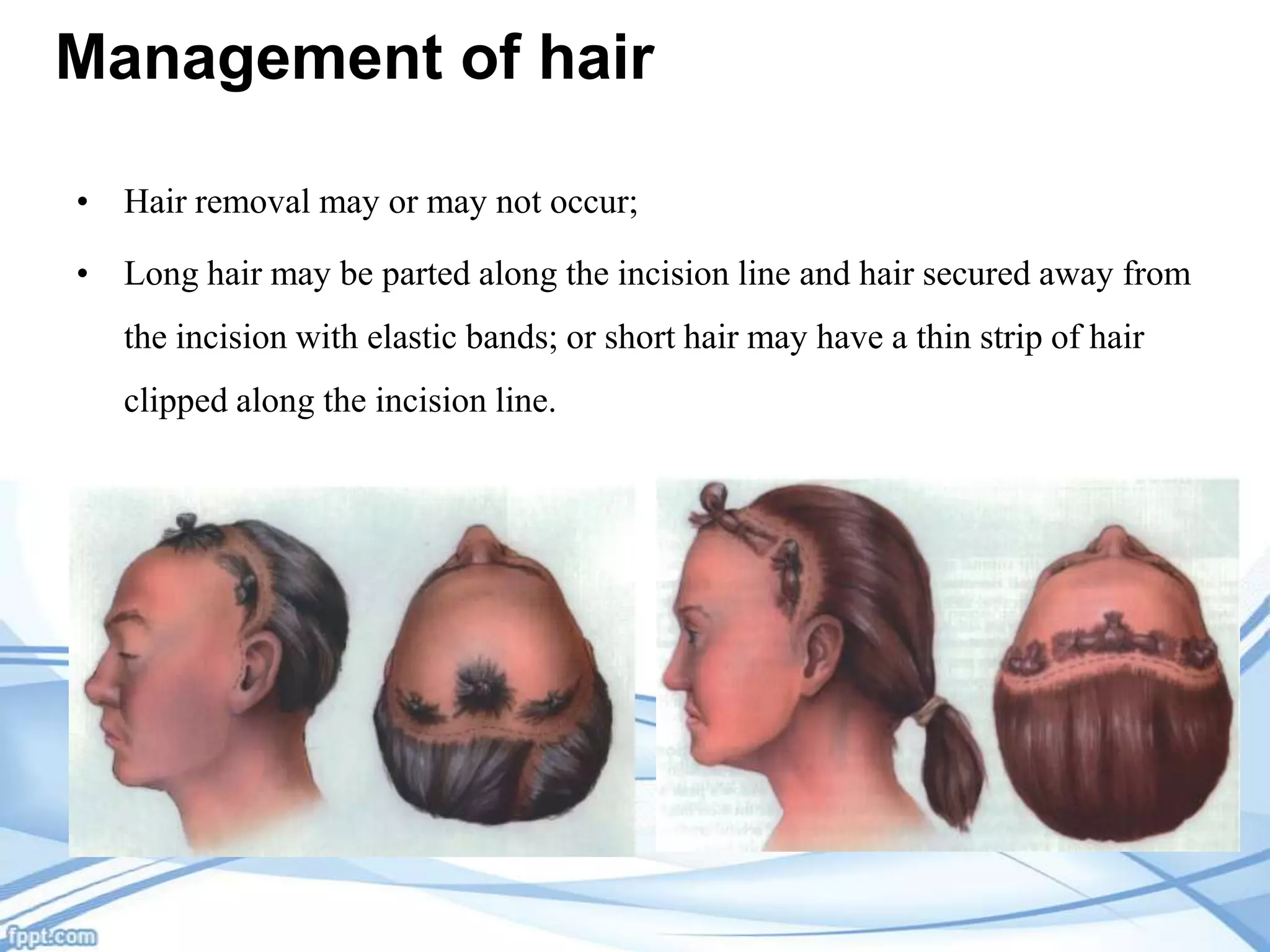 Management of hair
• Hair removal may or may not occur;
• Long hair may be parted along the incision line and hair secured away from

the incision with elastic bands; or short hair may have a thin strip of hair
clipped along the incision line.

 