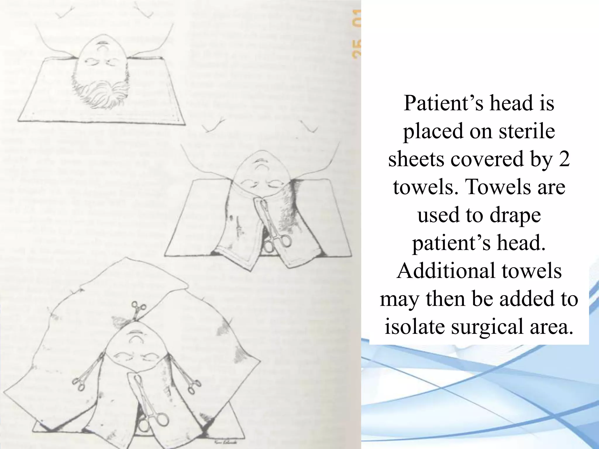 Patient’s head is
placed on sterile
sheets covered by 2
towels. Towels are
used to drape
patient’s head.
Additional towels
may then be added to
isolate surgical area.

 