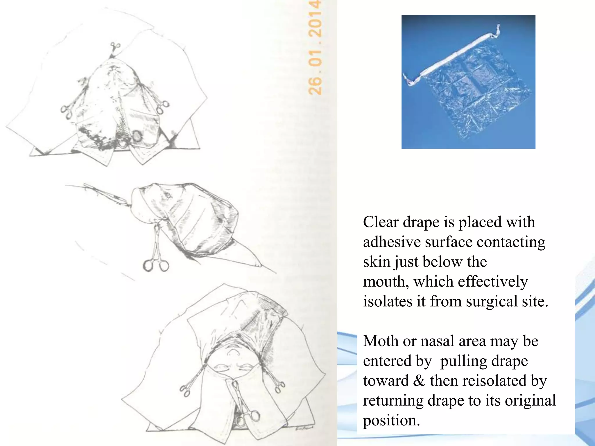 Clear drape is placed with
adhesive surface contacting
skin just below the
mouth, which effectively
isolates it from surgical site.
Moth or nasal area may be
entered by pulling drape
toward & then reisolated by
returning drape to its original
position.

 