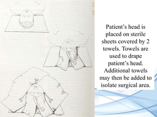Patient’s head is
placed on sterile
sheets covered by 2
towels. Towels are
used to drape
patient’s head.
Additional towels
may then be added to
isolate surgical area.

 