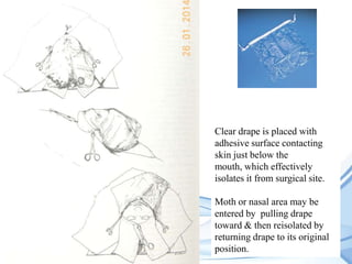 Clear drape is placed with
adhesive surface contacting
skin just below the
mouth, which effectively
isolates it from surgical site.
Moth or nasal area may be
entered by pulling drape
toward & then reisolated by
returning drape to its original
position.

 