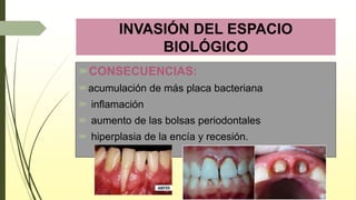 INVASIÓN DEL ESPACIO
BIOLÓGICO
CONSECUENCIAS:
acumulación de más placa bacteriana
 inflamación
 aumento de las bolsas periodontales
 hiperplasia de la encía y recesión.
 