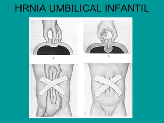 HRNIA UMBILICAL INFANTIL