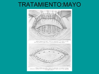 TRATAMIENTO:MAYO