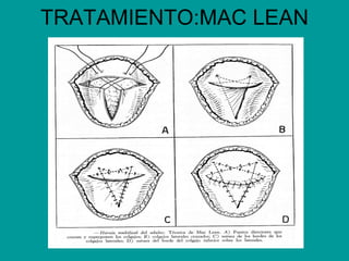 TRATAMIENTO:MAC LEAN