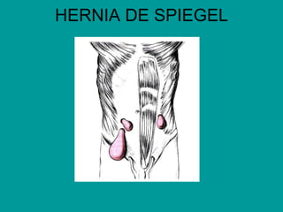 HERNIA DE SPIEGEL