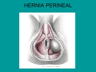 HERNIA PERINEAL