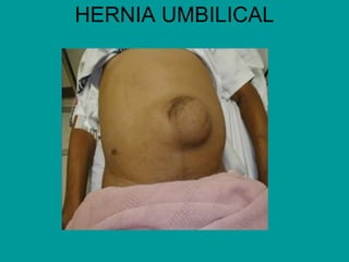 HERNIA UMBILICAL