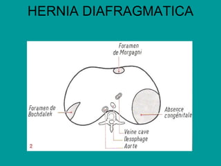 HERNIA DIAFRAGMATICA