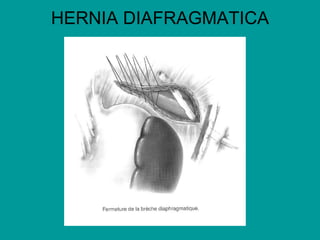 HERNIA DIAFRAGMATICA