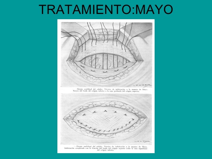 Otras Hernias Otras Hernias