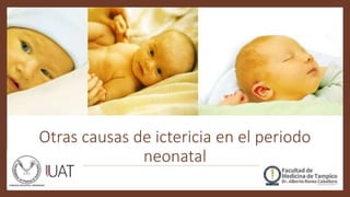 Otras causas de ictericia en el periodo
neonatal
 