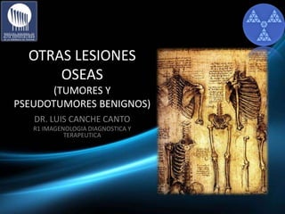 OTRAS LESIONES
OSEAS
(TUMORES Y
PSEUDOTUMORES BENIGNOS)
DR. LUIS CANCHE CANTO
R1 IMAGENOLOGIA DIAGNOSTICA Y
TERAPEUTICA
 