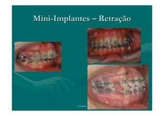 Mini-Implantes – Retração




           J. Ferreira
 