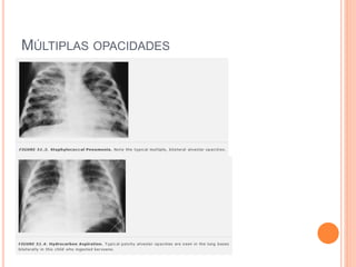MÚLTIPLAS OPACIDADES
 