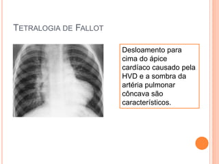 TETRALOGIA DE FALLOT
Desloamento para
cima do ápice
cardíaco causado pela
HVD e a sombra da
artéria pulmonar
côncava são
característicos.
 