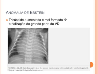 ANOMALIA DE EBSTEIN
 Tricúspide aumentada e mal formada 
atrialização de grande parte do VD
 