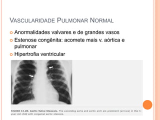 VASCULARIDADE PULMONAR NORMAL
 Anormalidades valvares e de grandes vasos
 Estenose congênita: acomete mais v. aórtica e
pulmonar
 Hipertrofia ventricular
 