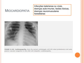MIOCARDIOPATIA
Infecções baterianas ou virais,
doenças auto-imunes, lesões tóxicas,
doenças neuromusculares
hereditárias
 