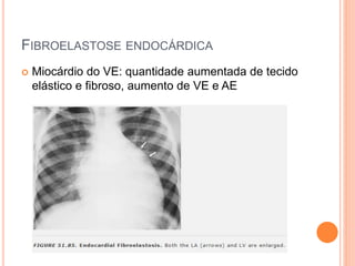 FIBROELASTOSE ENDOCÁRDICA
 Miocárdio do VE: quantidade aumentada de tecido
elástico e fibroso, aumento de VE e AE
 