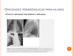 OPACIDADES PERIBRÔNQUICAS PARA-HILARES
Comum adenopatia hilar bilateral e atelectasia
 
