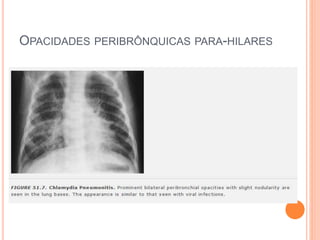 OPACIDADES PERIBRÔNQUICAS PARA-HILARES
 