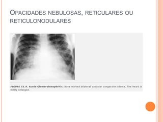 OPACIDADES NEBULOSAS, RETICULARES OU
RETICULONODULARES
 