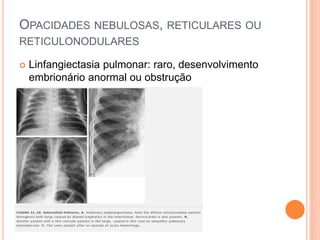  Linfangiectasia pulmonar: raro, desenvolvimento
embrionário anormal ou obstrução
OPACIDADES NEBULOSAS, RETICULARES OU
RETICULONODULARES
 