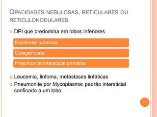  DPI que predomina em lobos inferiores
 Leucemia, linfoma, metástases linfáticas
 Pneumonite por Mycoplasma: padrão intersticial
confinado a um lobo
OPACIDADES NEBULOSAS, RETICULARES OU
RETICULONODULARES
Esclerose tuberosa
Colagenoses
Pneumonite intersticial primária
 