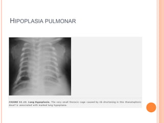 HIPOPLASIA PULMONAR
 