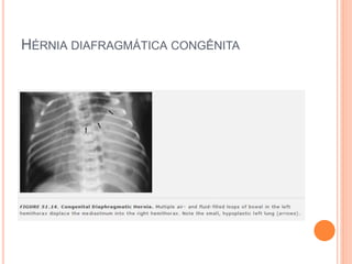 HÉRNIA DIAFRAGMÁTICA CONGÊNITA
 