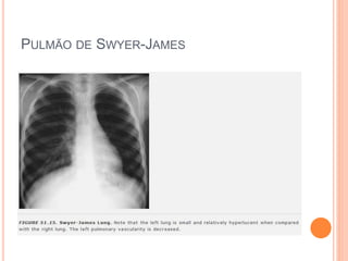 PULMÃO DE SWYER-JAMES
 