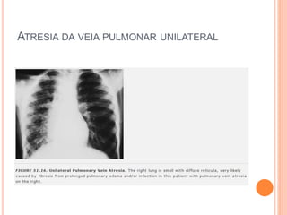 ATRESIA DA VEIA PULMONAR UNILATERAL
 