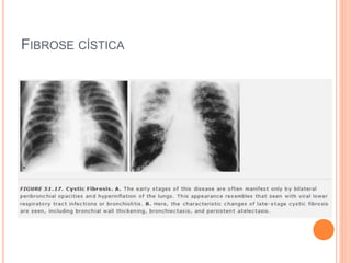 FIBROSE CÍSTICA
 