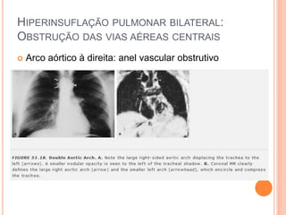  Arco aórtico à direita: anel vascular obstrutivo
HIPERINSUFLAÇÃO PULMONAR BILATERAL:
OBSTRUÇÃO DAS VIAS AÉREAS CENTRAIS
 
