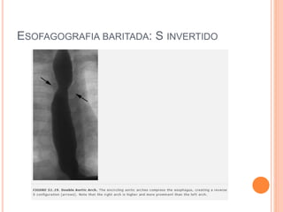 ESOFAGOGRAFIA BARITADA: S INVERTIDO
 