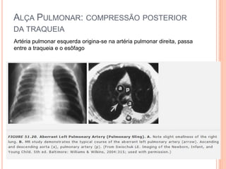 ALÇA PULMONAR: COMPRESSÃO POSTERIOR
DA TRAQUEIA
Artéria pulmonar esquerda origina-se na artéria pulmonar direita, passa
entre a traqueia e o esôfago
 
